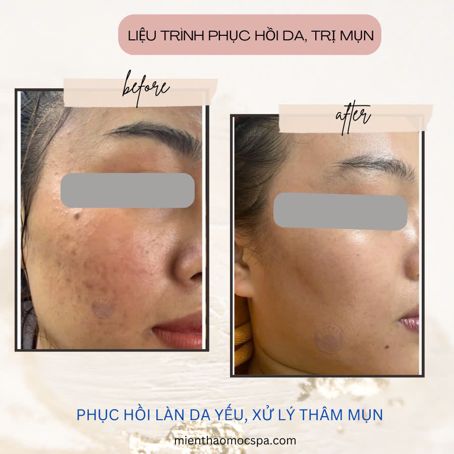 lay-nhan-mun-chuan-y-khoa-chi-voi-99k-3
