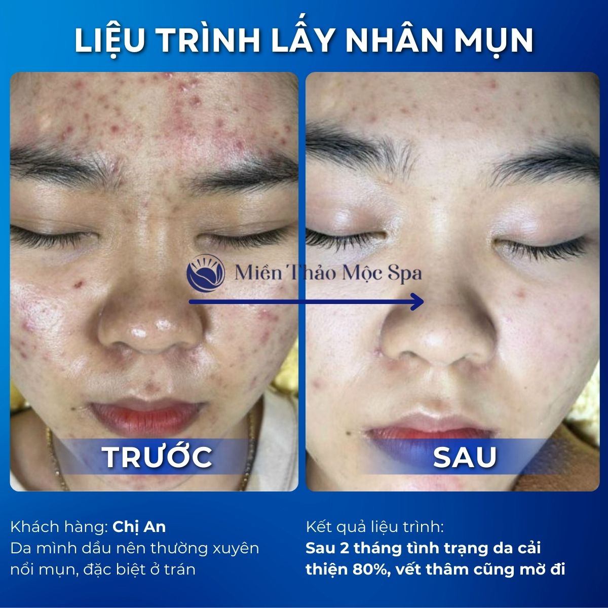 Trị mụn bằng thuốc hay spa tốt hơn