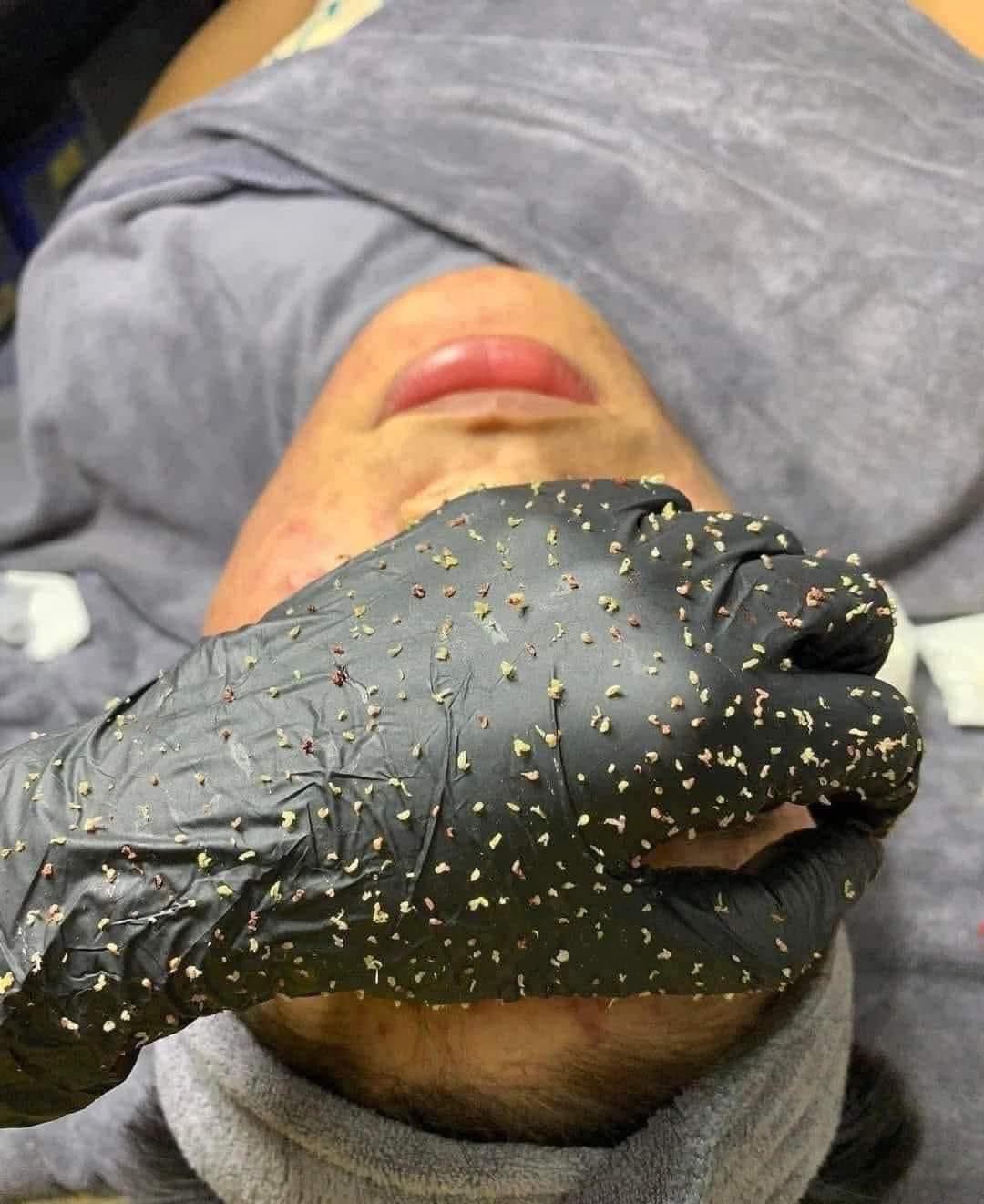 Cách Chăm Da Sau Khi Đi Lấy Nhân Mụn Ở Spa Để Da Nhanh Hồi Phục