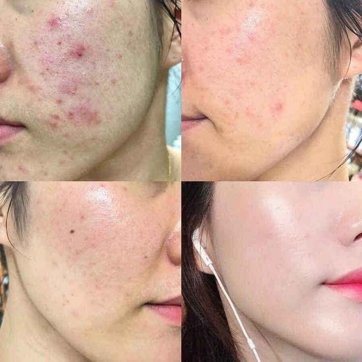 Cách chăm sóc da mụn không để lại thâm