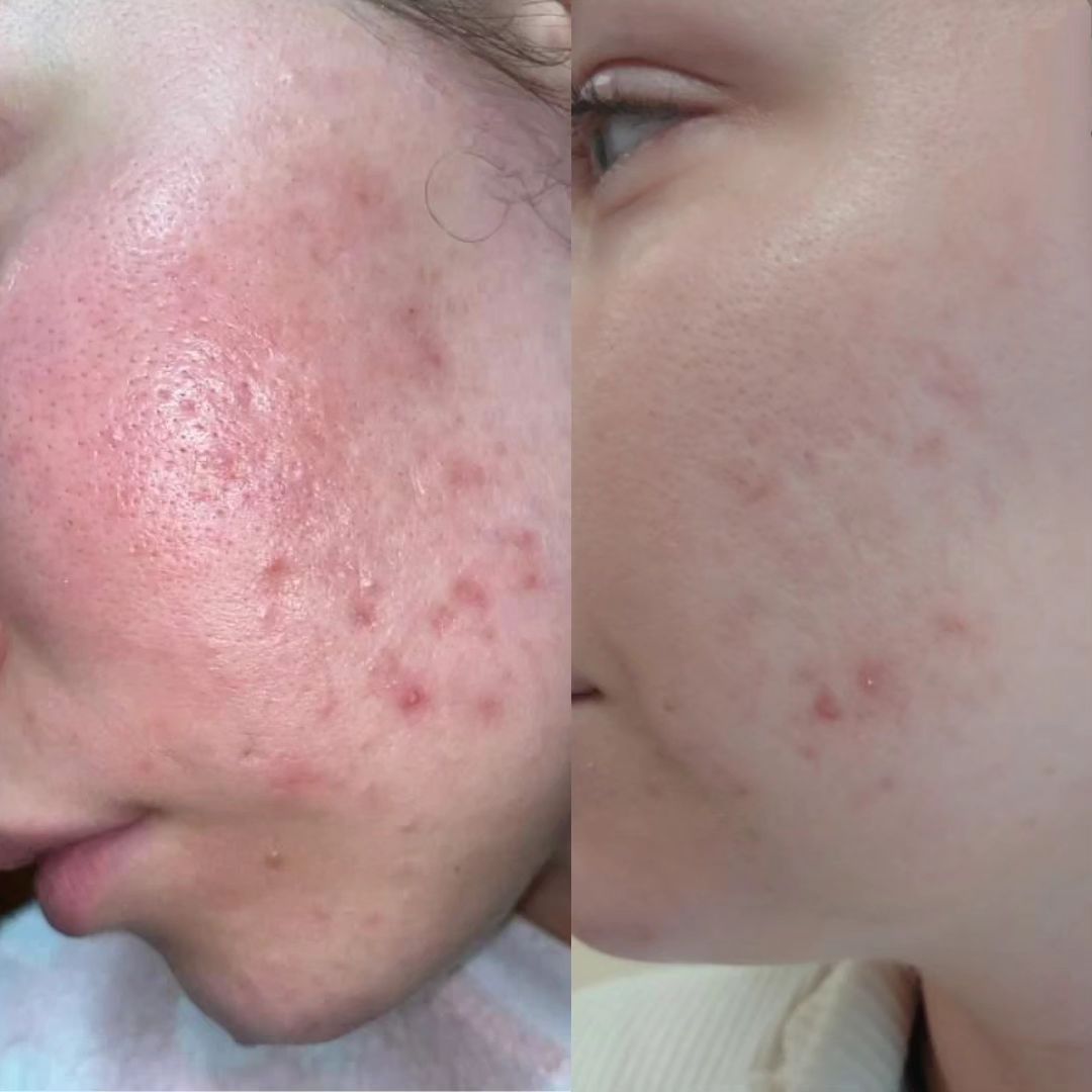 Cách chăm sóc da mụn không để lại thâm