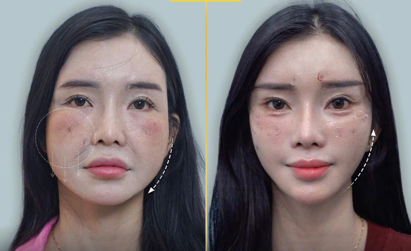 Căng Chỉ PDO Và PCL Khác Nhau Như Thế Nào