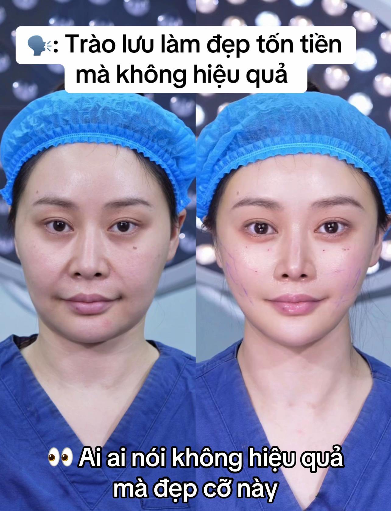 Căng Chỉ PDO Và PCL Khác Nhau Như Thế Nào