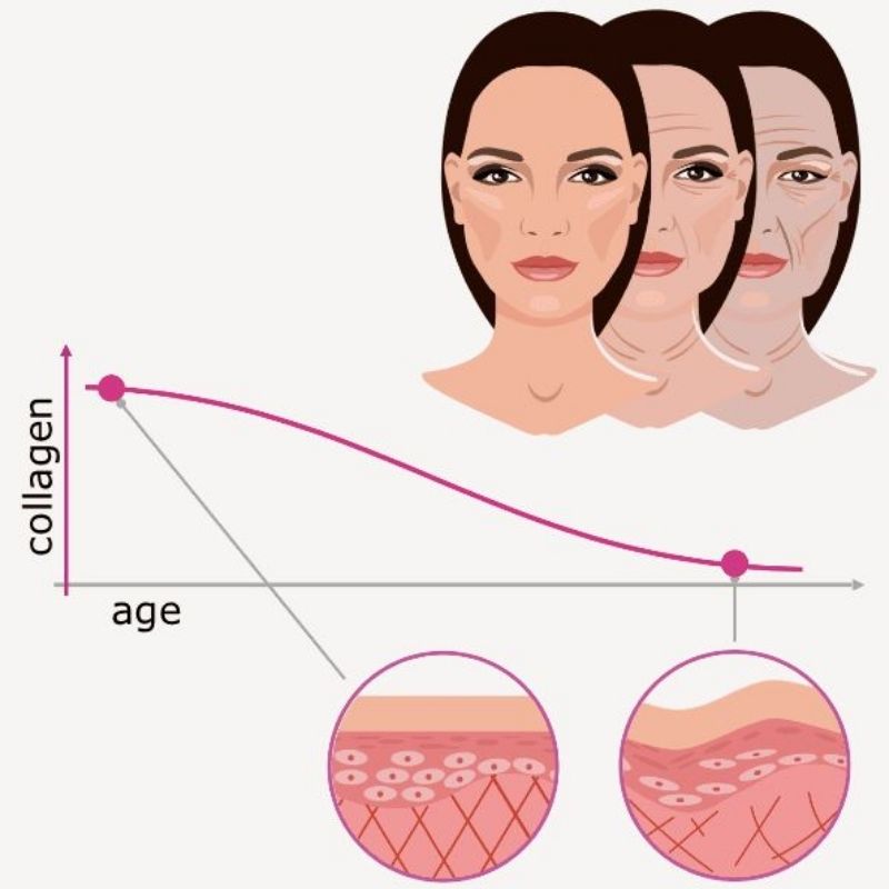 Căng chỉ bằng Bột Chỉ Có Đau Không? Bao Lâu Thì Đẹp?