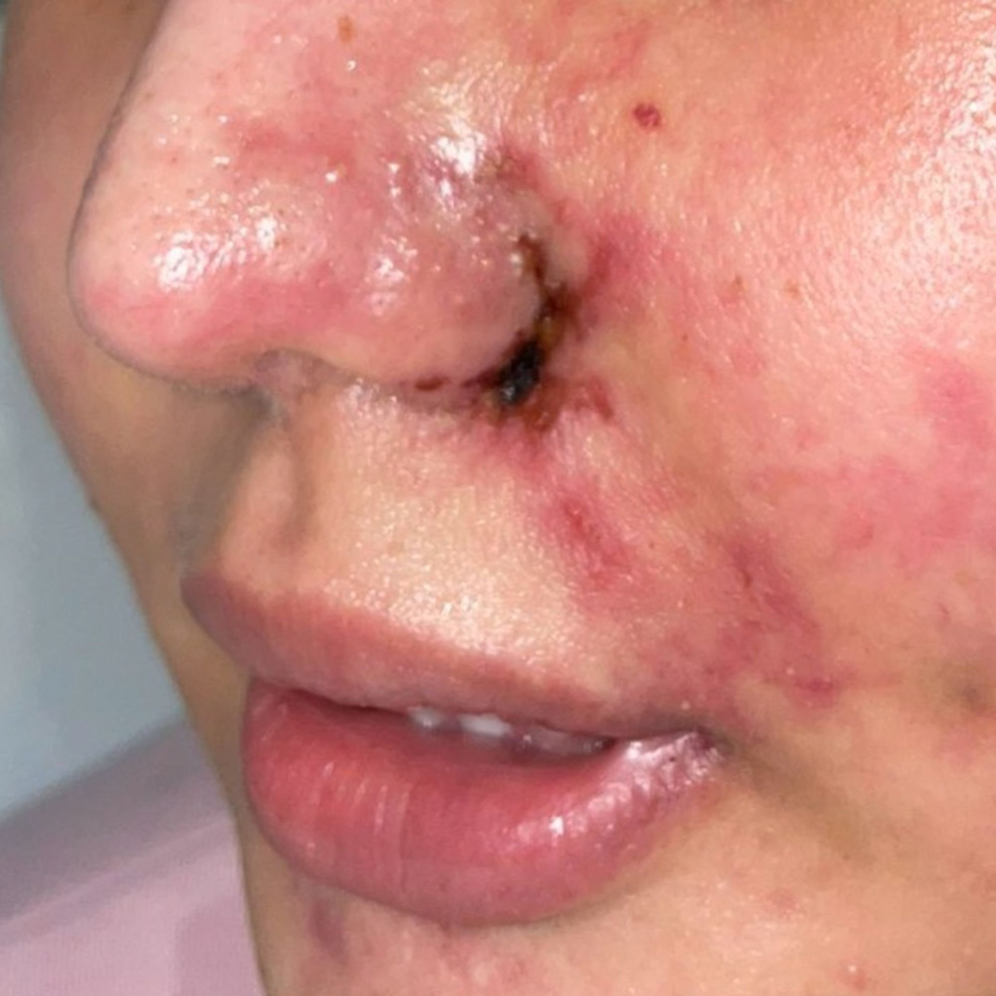Cảnh Báo: Tiêm Filler Giá Rẻ Có Thể Gây Hỏng Mặt Vĩnh Viễn