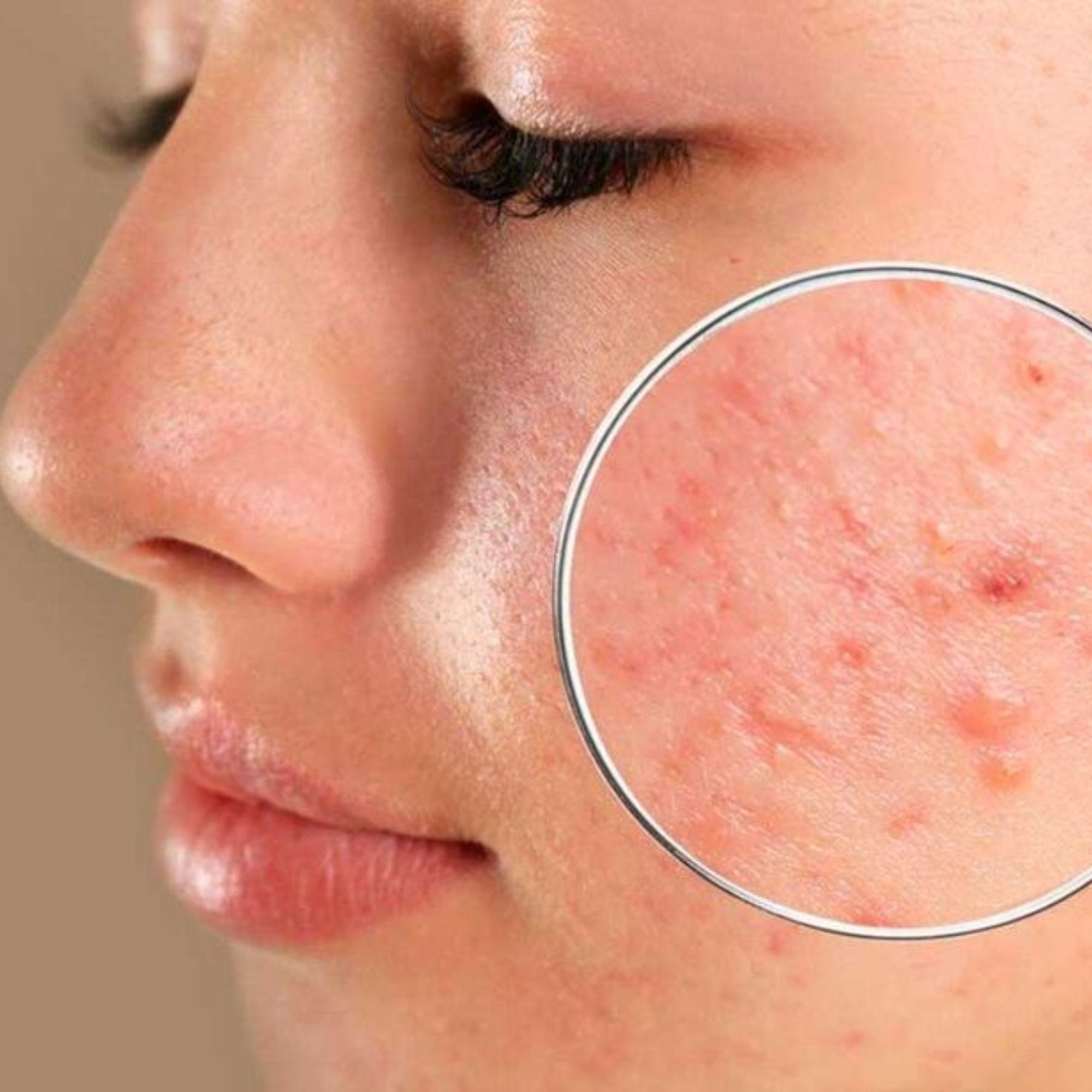 Điều Trị Da Nhiễm Corticoid Tại Spa Có Tốt Không?