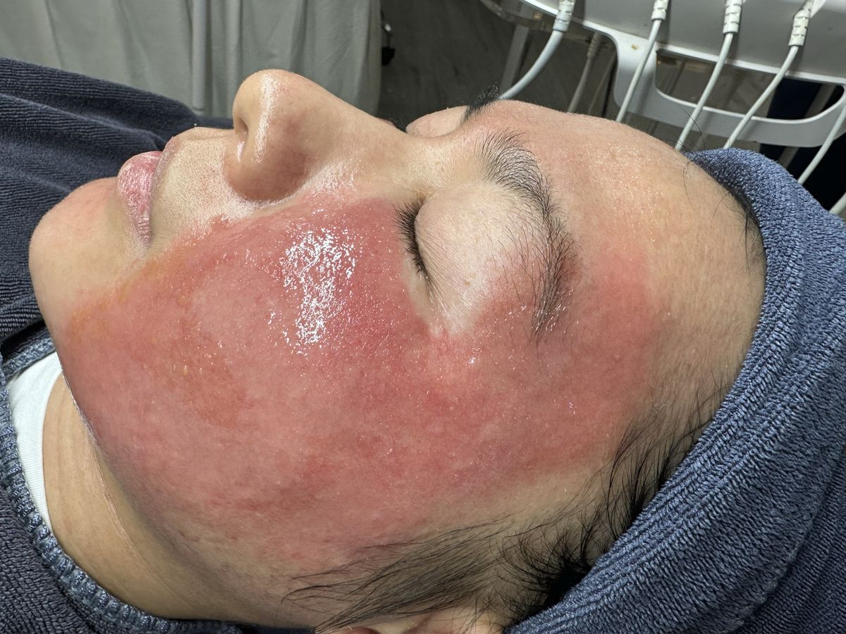 Điều trị da nhiễm corticoid tại spa có tốt không