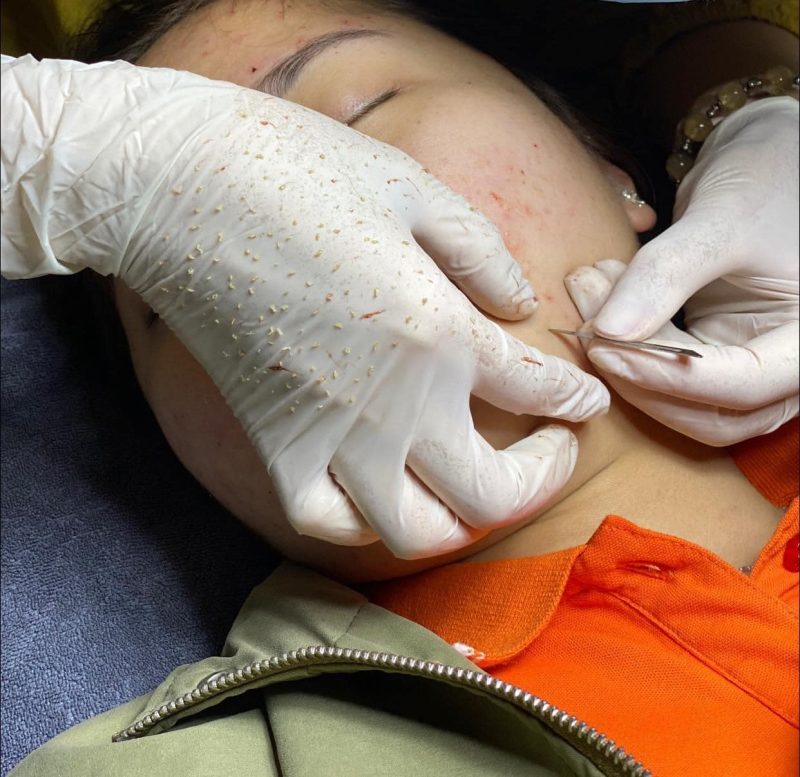 Lấy Nhân Mụn Chuẩn Y Khoa Là Gì