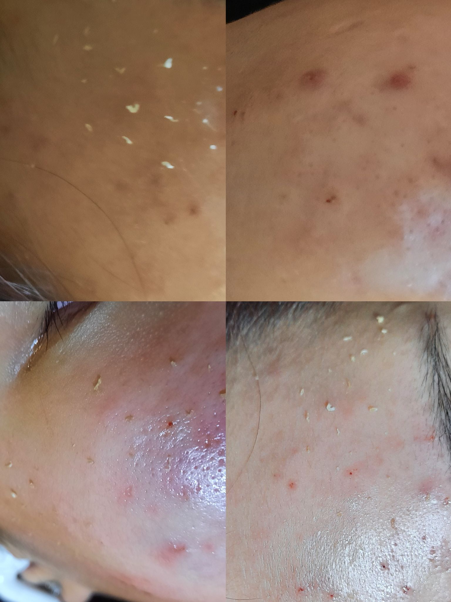 Lấy nhân mụn có nên làm tại nhà không?