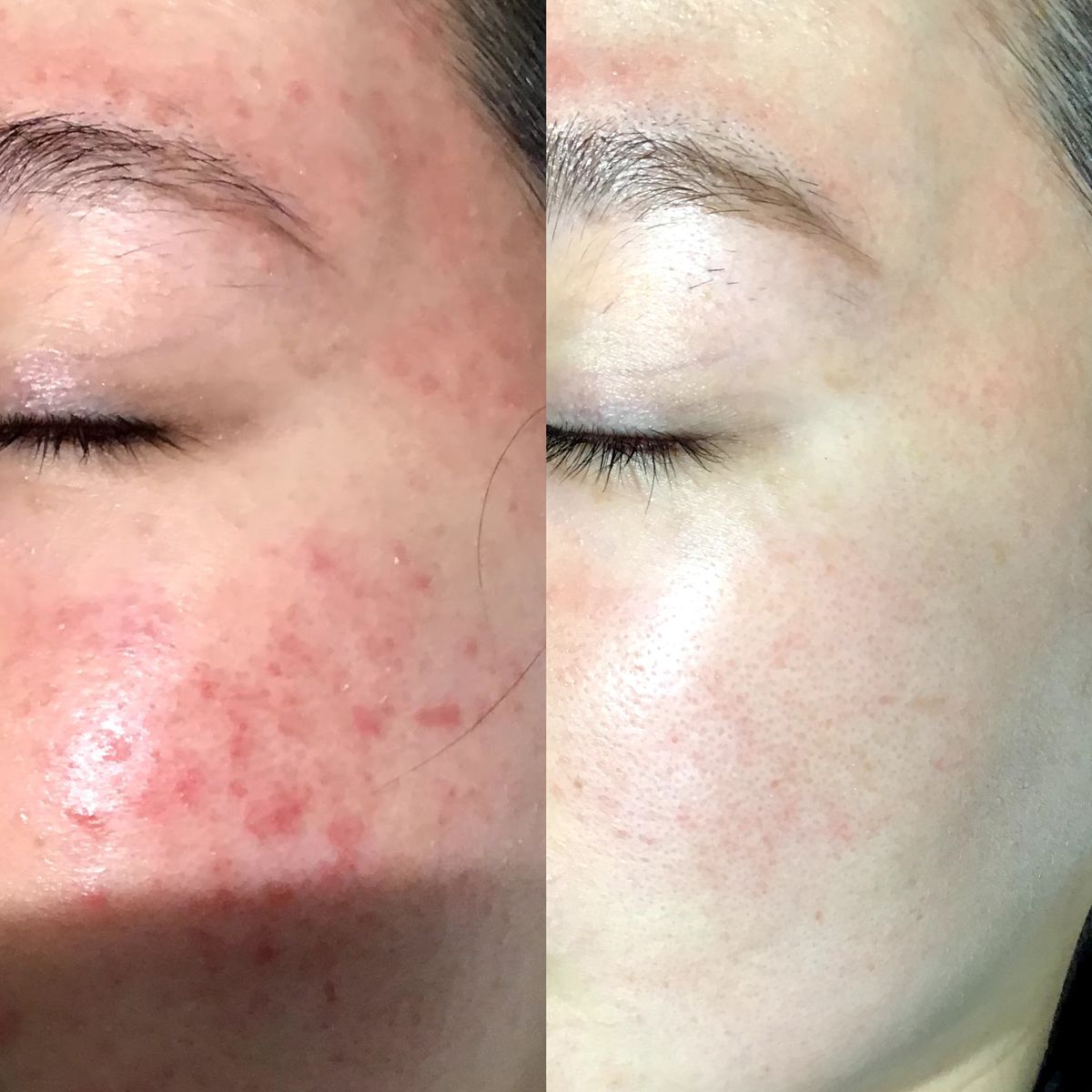 Lỡ Dùng Đồ Trộn Mà Ngưng Corticoid Đột Ngột Có Sao Không