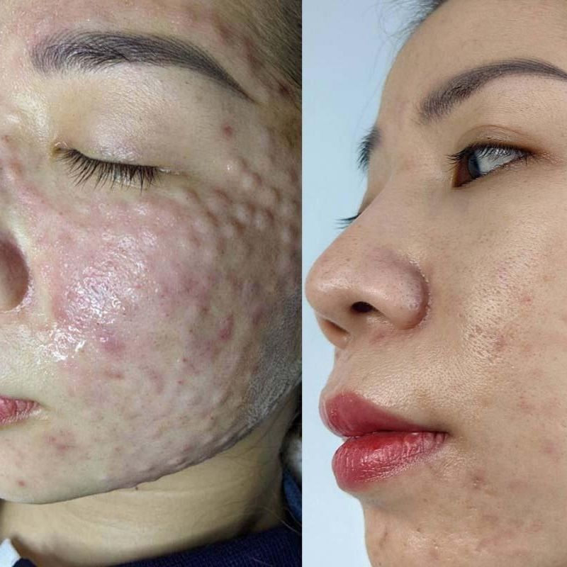 Mesotherapy Và PRP Khác Nhau Như Thế Nào?