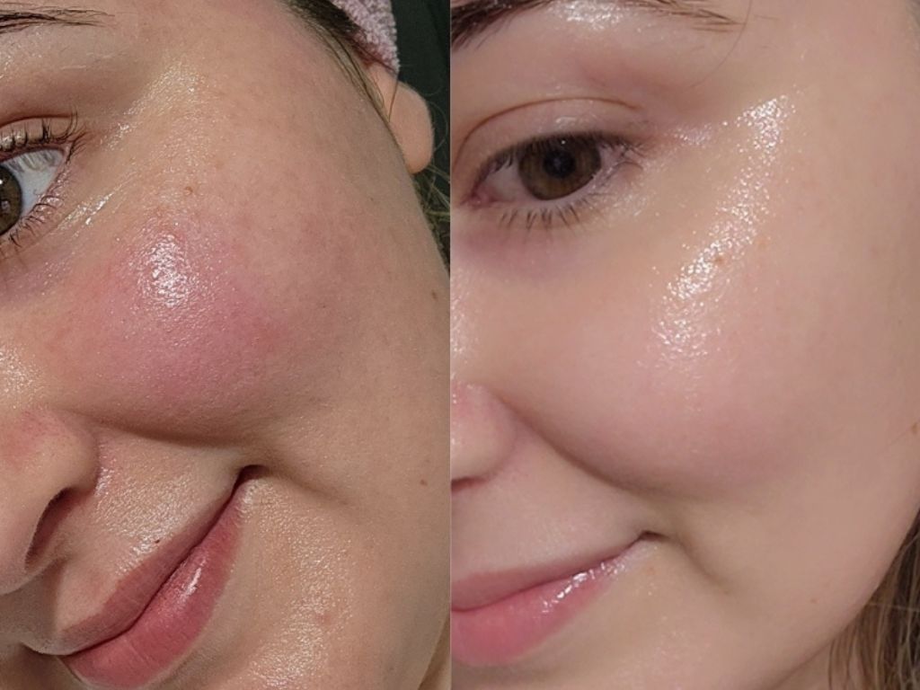 Ngưng corticoid đột ngột có sao không?
