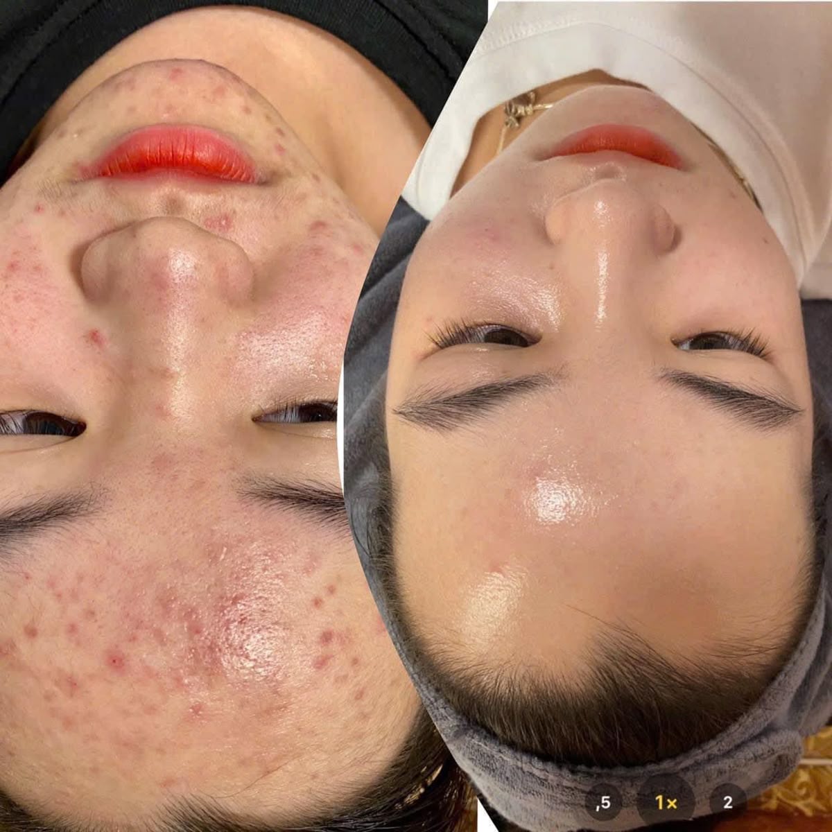 Người Bị Mụn Viêm Có Tiêm Mesotherapy Được Không