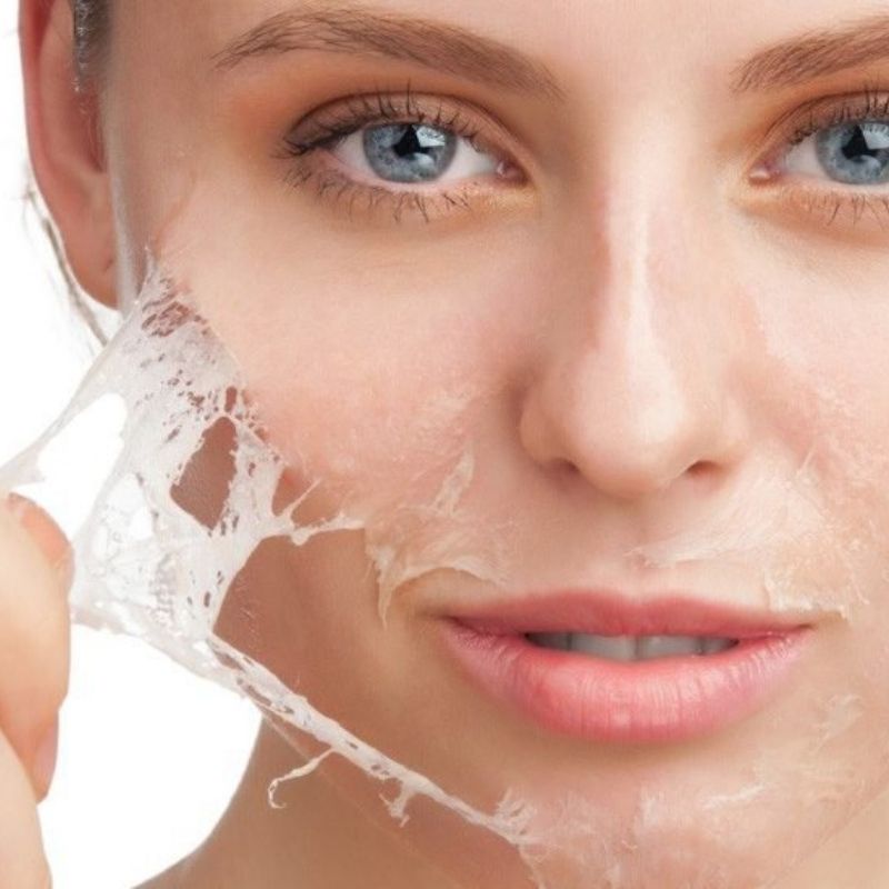 Peel Da Có Giúp Hết Mụn Ẩn, Mụn Viêm Không?