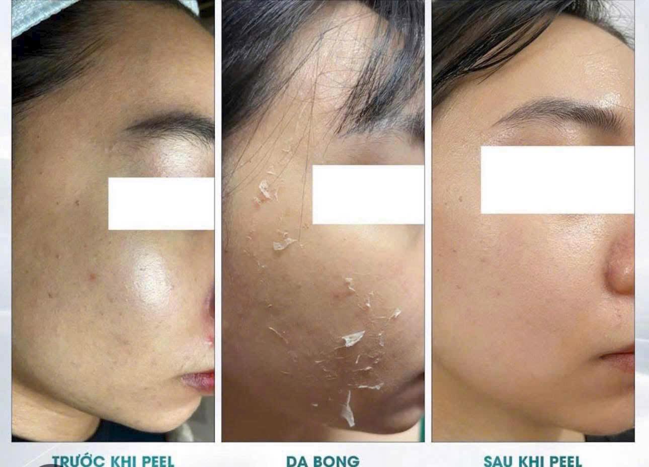 Peel da căng bóng dùng hoạt chất nào