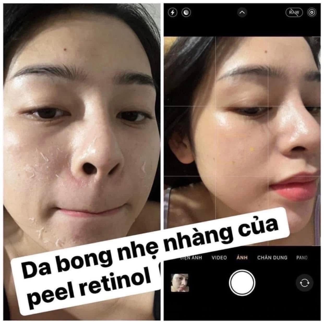 Peel da căng bóng dùng hoạt chất nào
