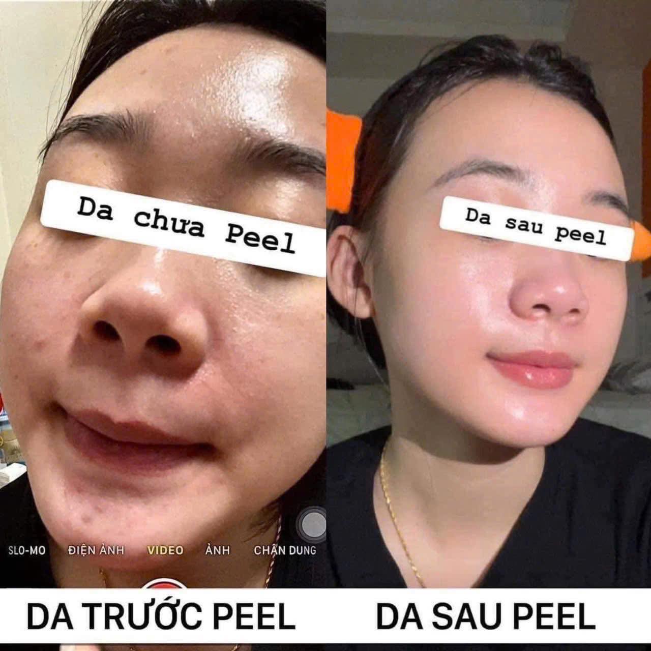 Peel da căng bóng dùng hoạt chất nào