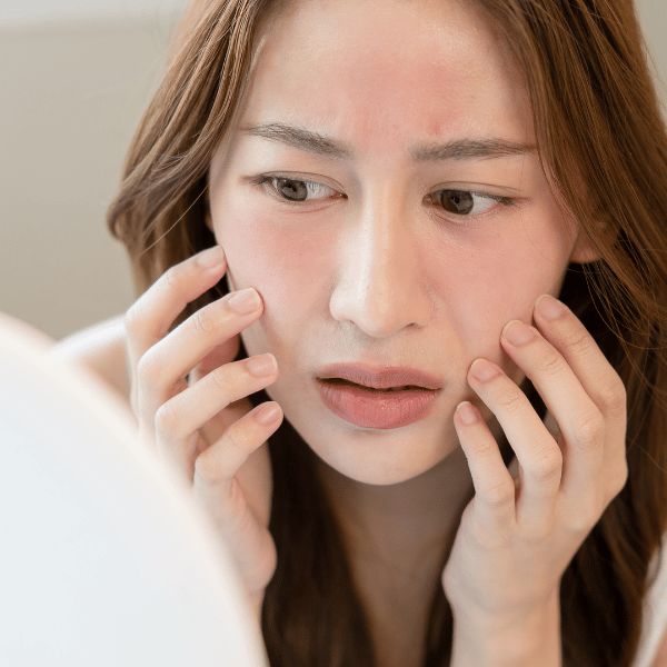 Phục Hồi Da Nhiễm Corticoid Mất Bao Lâu