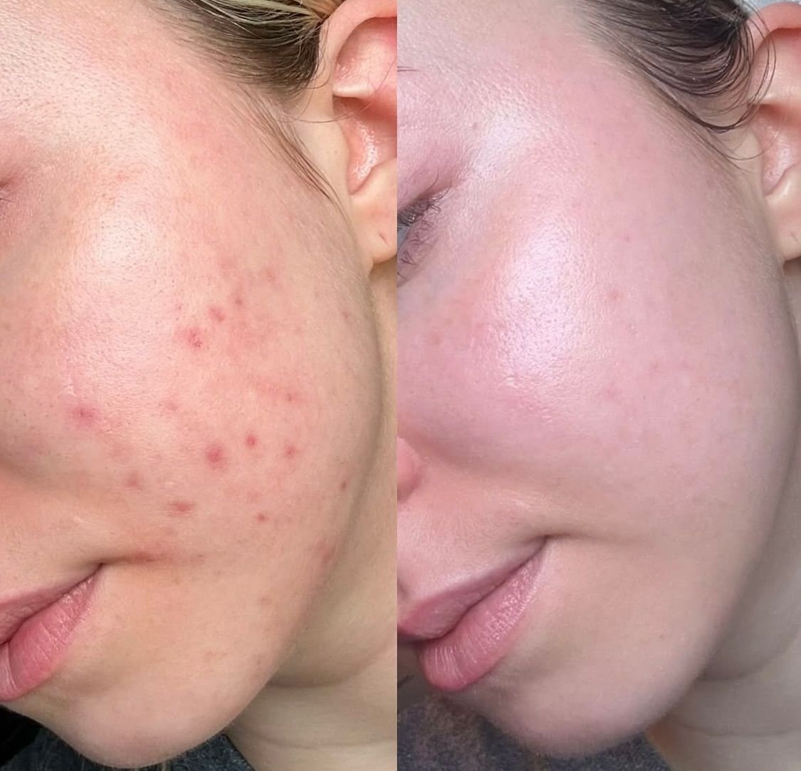 Sau Khi Lấy Nhân Mụn Bao Lâu Thì Hết Đỏ