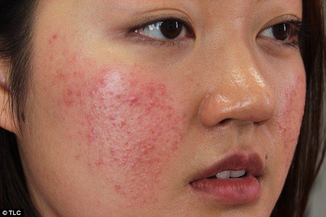 Trị mụn bằng thuốc hay spa tốt hơn