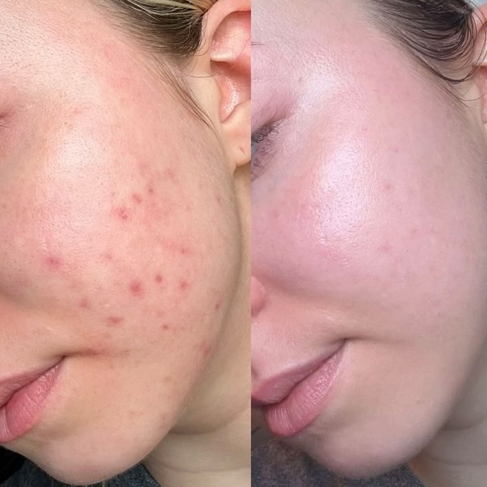 Trị mụn spa bao lâu hết