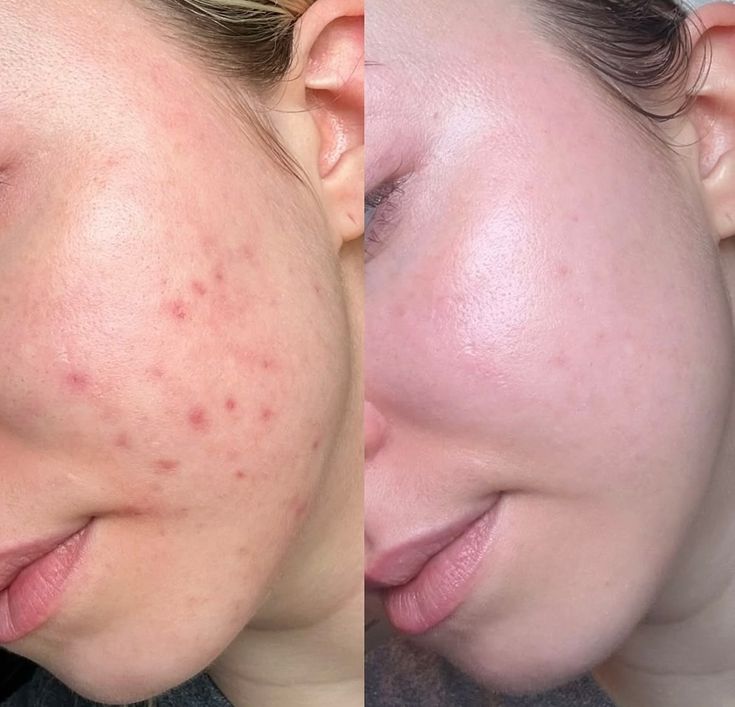 Trị mụn spa bao lâu hết