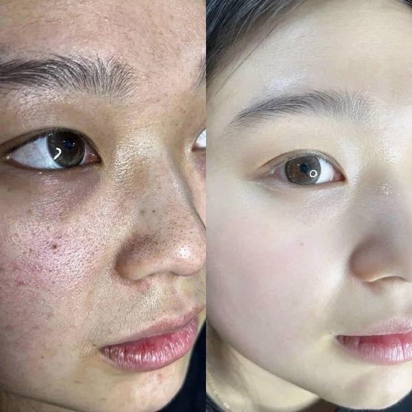 Trị mụn spa bao lâu hết
