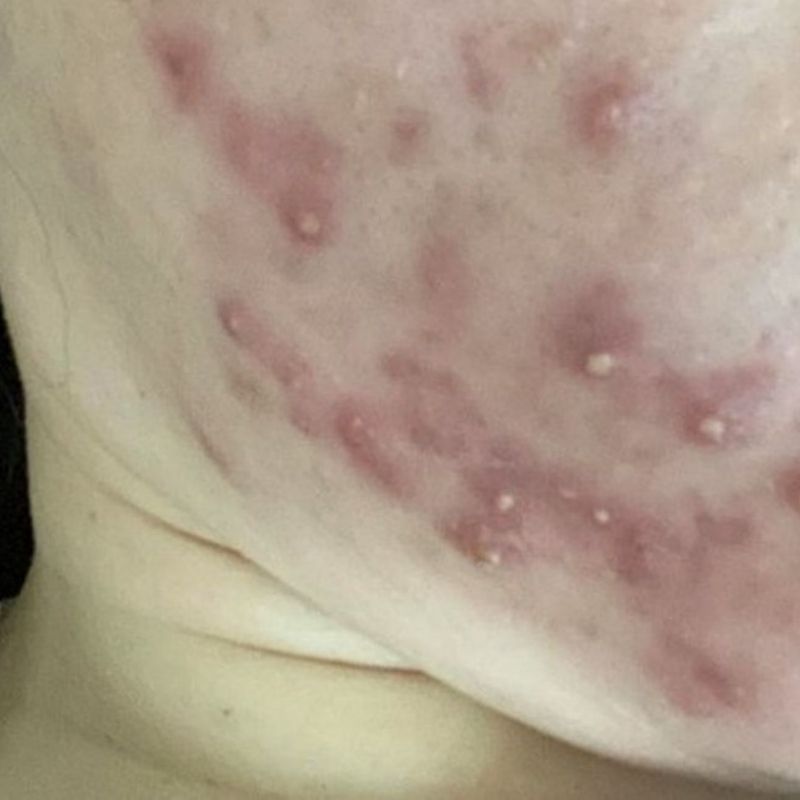 Vì Sao Peel Da Mà Mụn Viêm Lại Nặng Hơn?