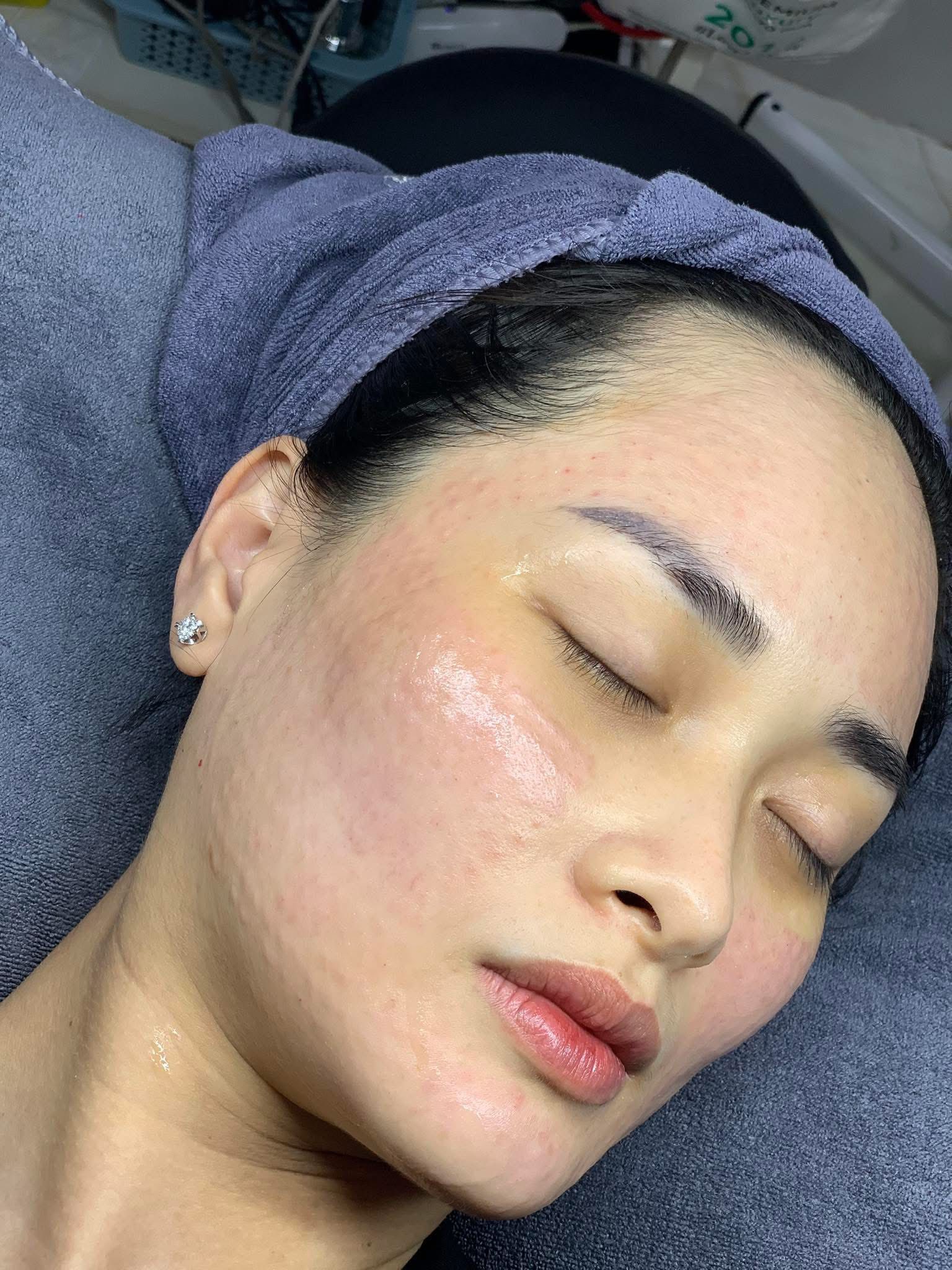 Mesotherapy Và PRP Khác Nhau Như Thế Nào?