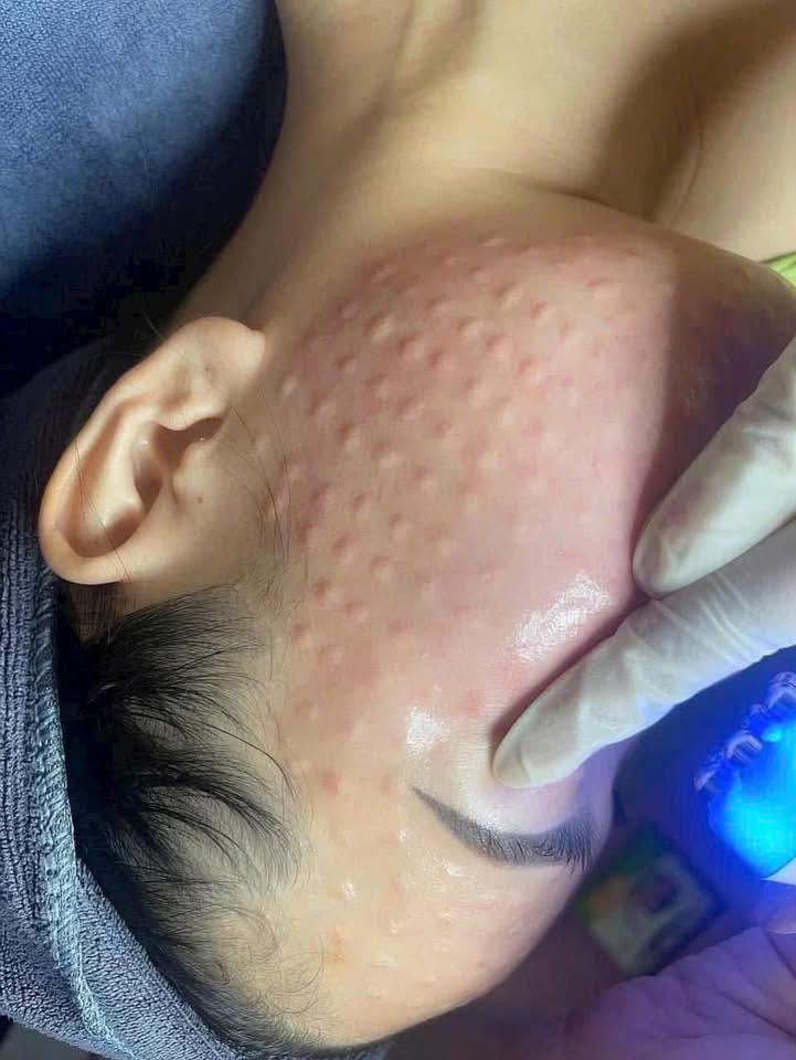 Mesotherapy Và PRP Khác Nhau Như Thế Nào?