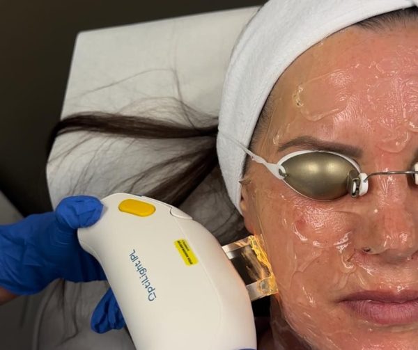 Điều Trị Mụn Bằng IPL Có Hiệu Quả Không