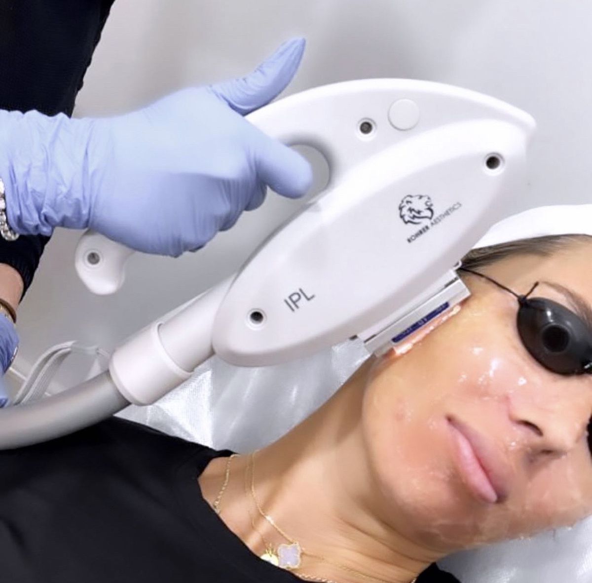 Điều Trị Mụn Bằng IPL Có Hiệu Quả Không