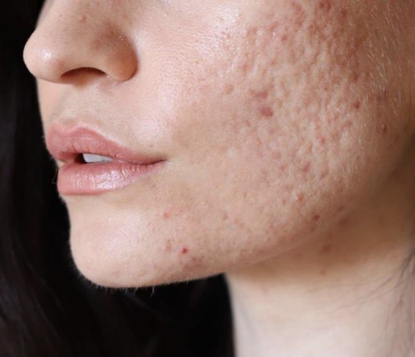 Lấy Nhân Mụn Xong Bị Thâm, Sẹo – Nguyên Nhân Do Đâu
