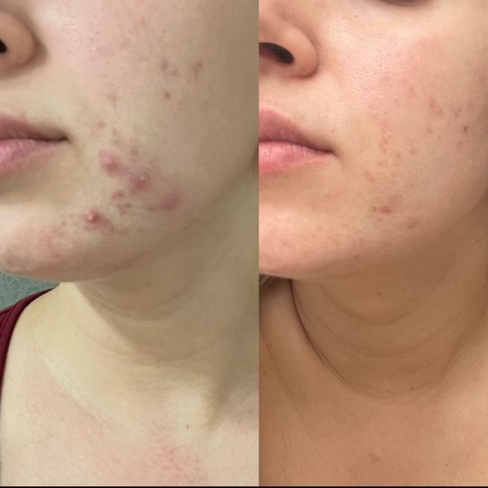 Lấy Nhân Mụn Xong Bị Thâm, Sẹo – Nguyên Nhân Do Đâu