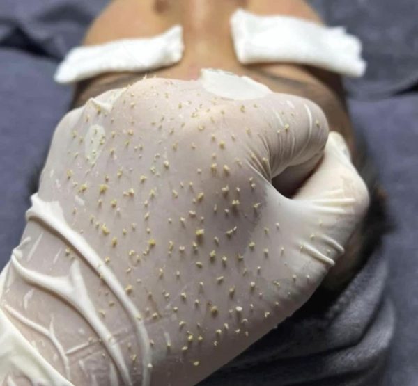 Lấy Nhân Mụn Xong Bị Thâm, Sẹo – Nguyên Nhân Do Đâu