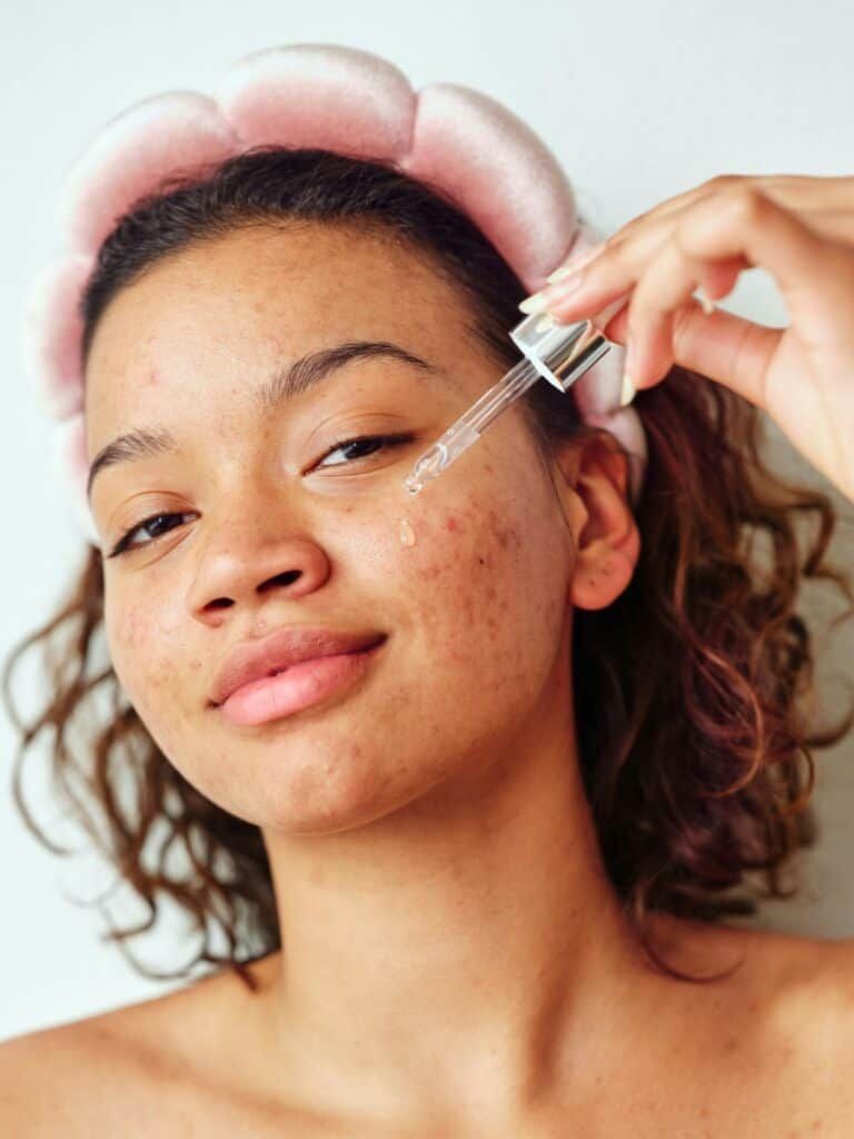 Mụn Viêm Sưng Đỏ Phải Làm Sao