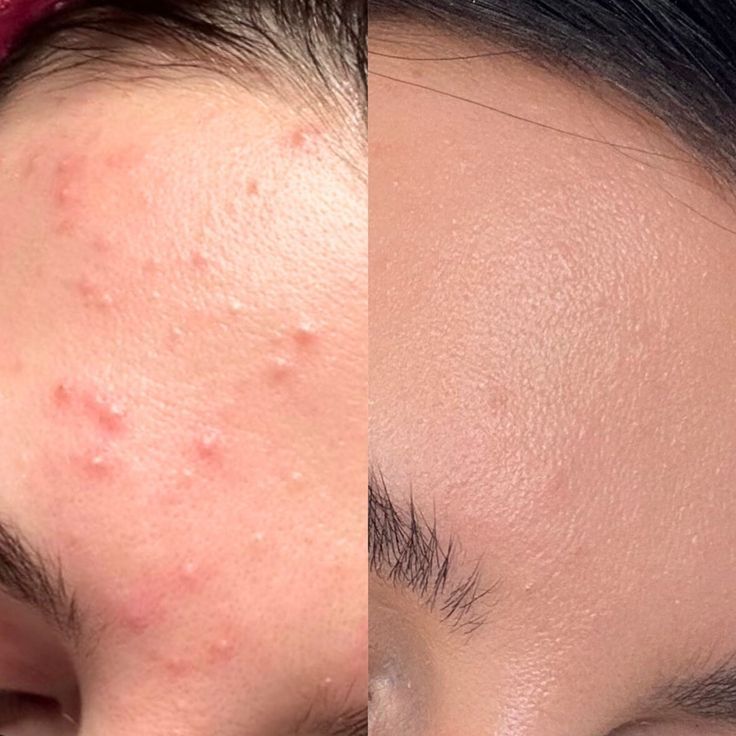 Mụn Viêm Sưng Đỏ Phải Làm Sao