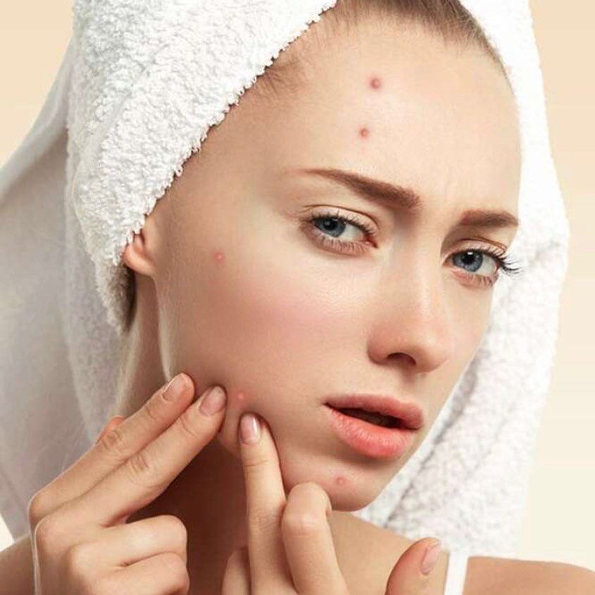Tại Sao Da Đang Đẹp Lại Nổi Mụn Nhiều