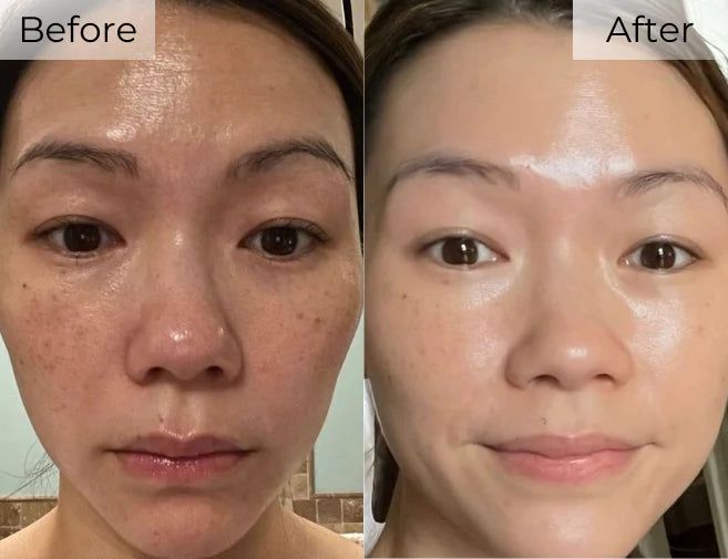 Trời Nắng Nóng, Da Đổ Dầu – Mụn Bùng Phát. Giải Pháp Tại Spa Bạn Nên Thử Ngay