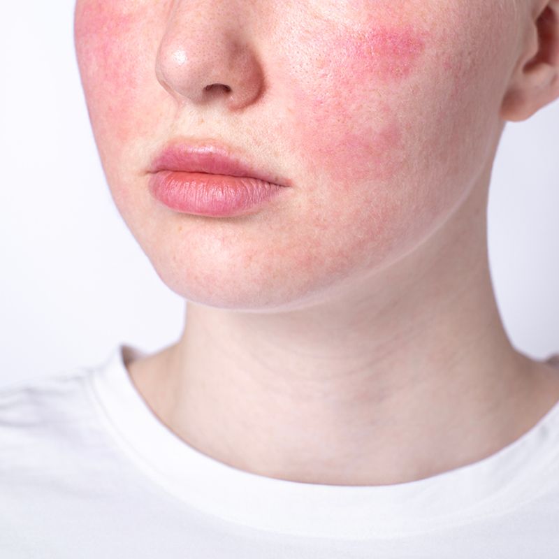 Tự Phục Hồi Da Nhiễm Corticoid Tại Nhà Hay Nên Đi Spa
