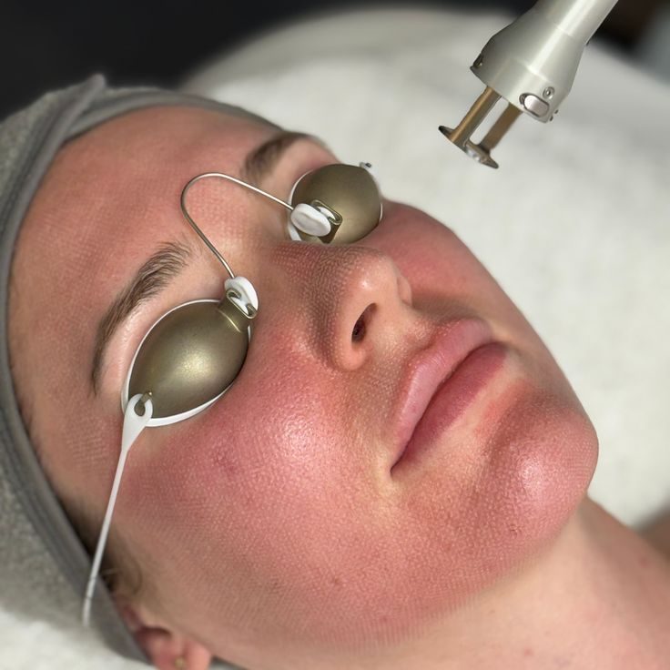 Chăm sóc da sau Laser thế nào