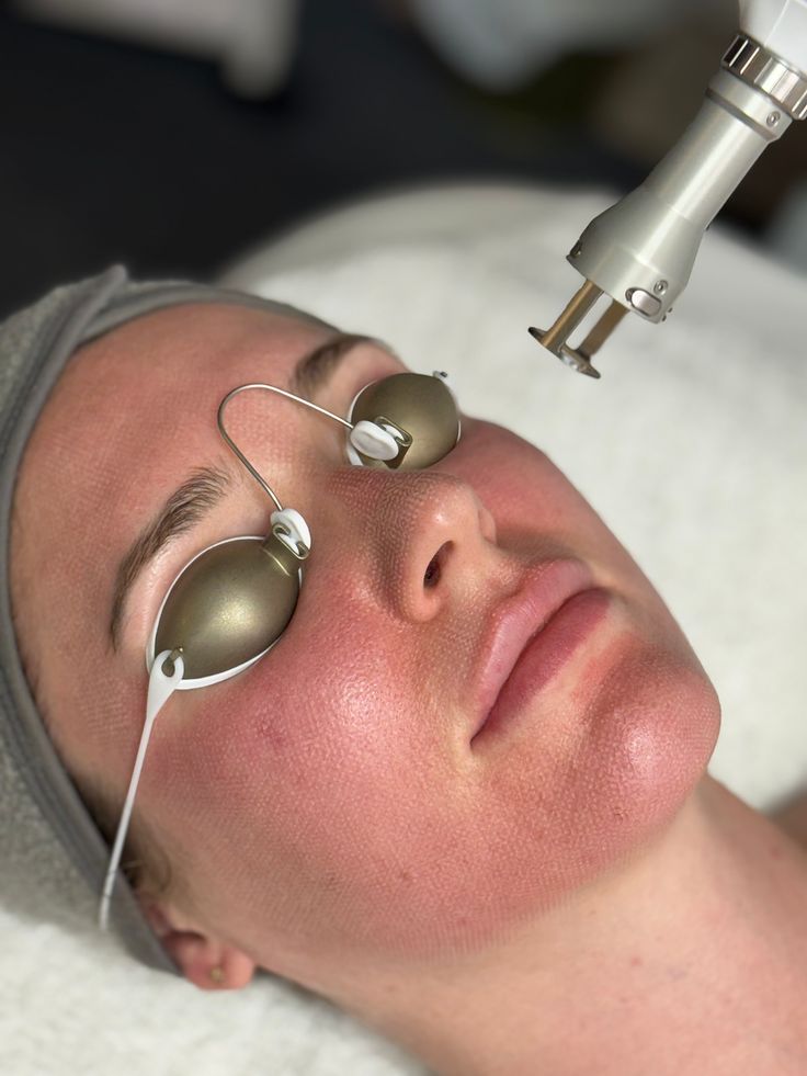Chăm sóc da sau Laser thế nào