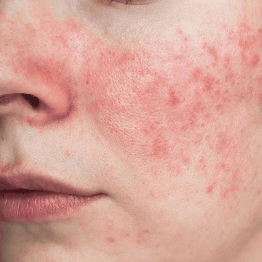 Da Mỏng Đỏ, Giãn Mao Mạch? Cảnh Báo Nhiễm Corticoid