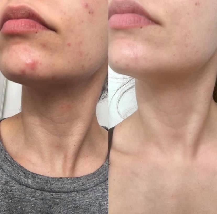 Mụn Nội Tiết Có Điều Trị Dứt Điểm Được Không