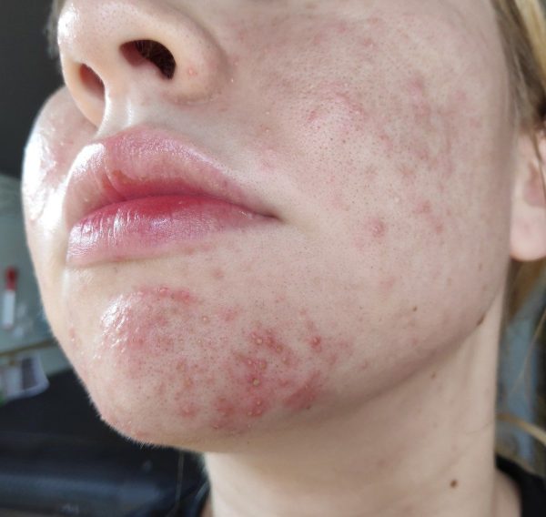 Mụn Nội Tiết Có Điều Trị Dứt Điểm Được Không