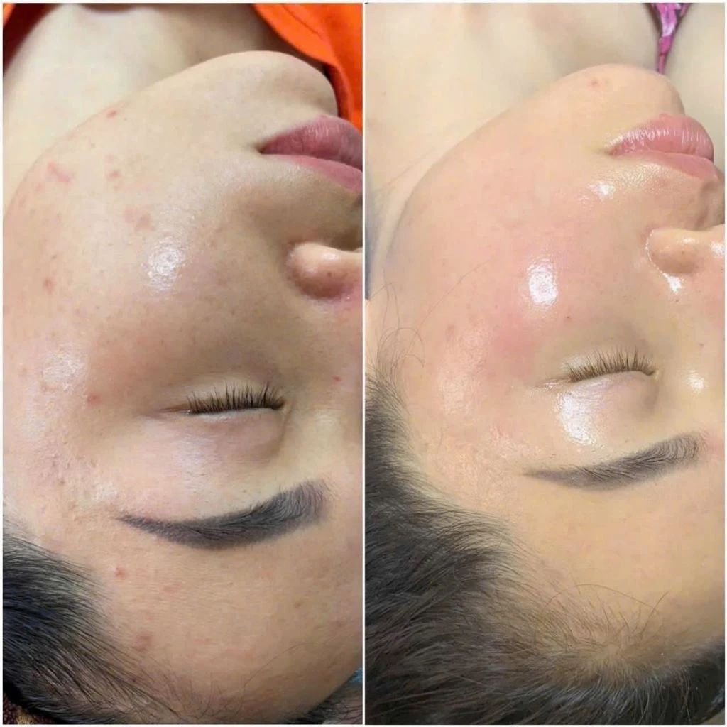 Tự Trị Mụn Tại Nhà Có Hiệu Quả Bằng Spa Không