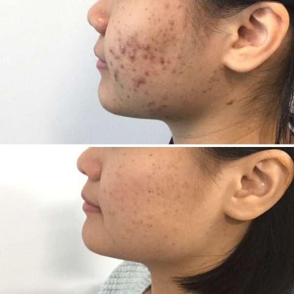 Vì Sao Da Dễ Thâm Sau Mụn?