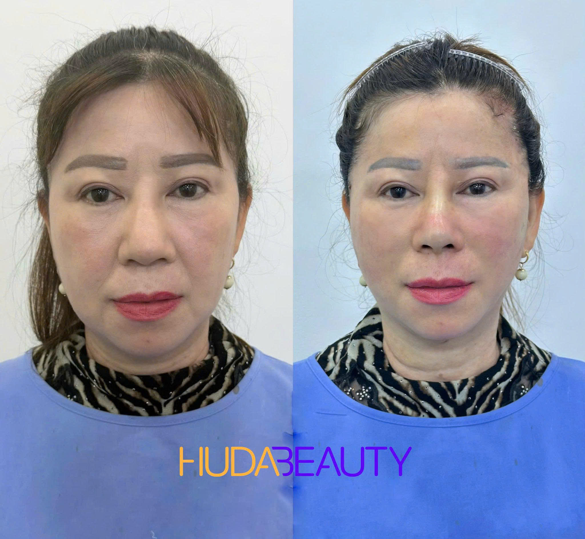 Có Nên Căng Chỉ Khi Da Mới Chớm Lão Hóa