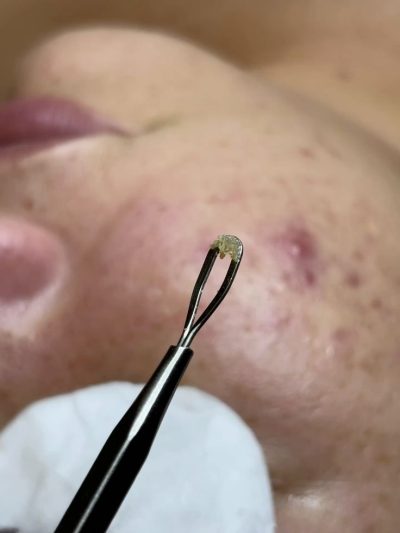 Lấy Nhân Mụn Có Bị Rỗ Mặt Không?