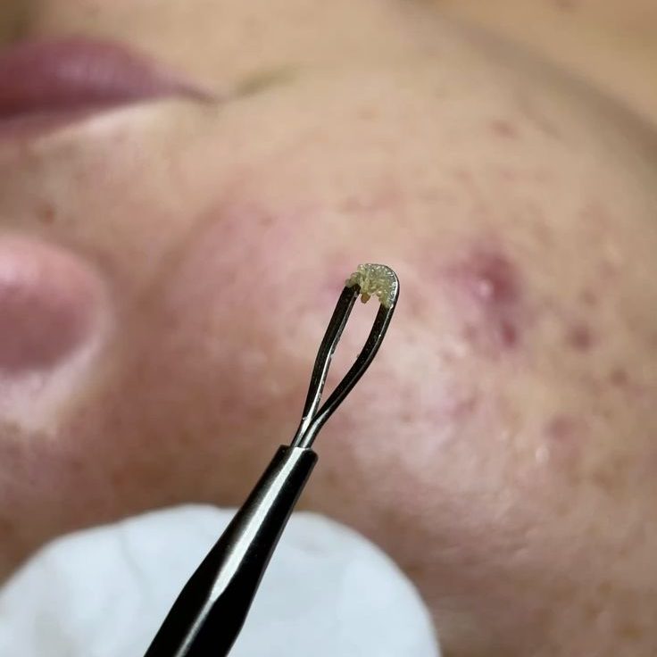 Lấy Nhân Mụn Có Bị Rỗ Mặt Không?
